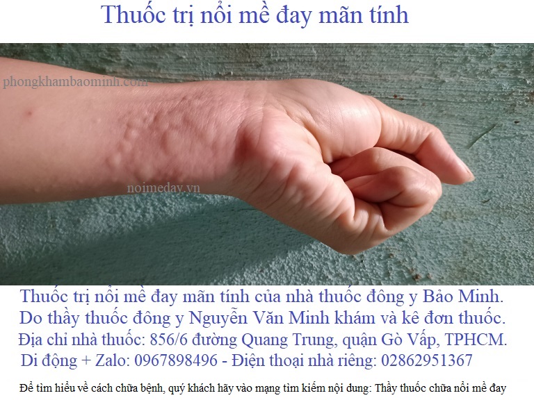 thuốc trị mề đay mãn tính